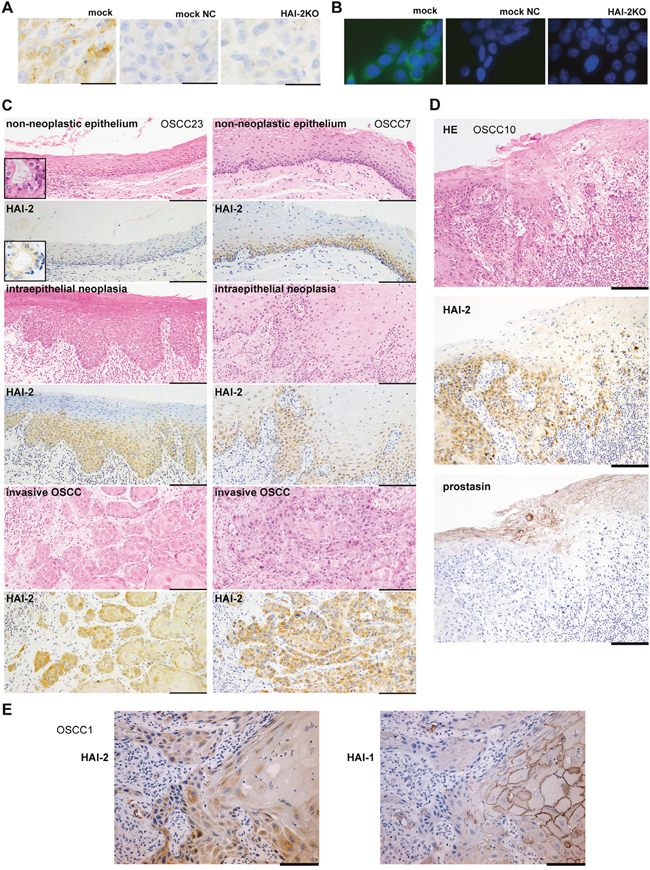 Immunohistochemistry of HAI-2 in OSCC tissues.