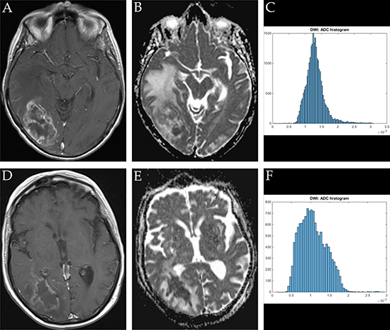 Imaging findings and corresponding ADC-histograms of morphologically resembling temporo-occipital manifestations of GBM and brain abscess.