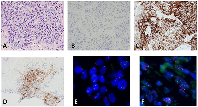Representative examples of PD-L1 protein expression by IHC and MET amplification by FISH.