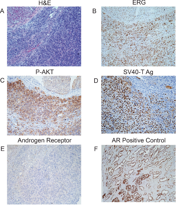 Characterization of tumors from PNT1A cells with PTEN knockdown and TE fusion gene expression.