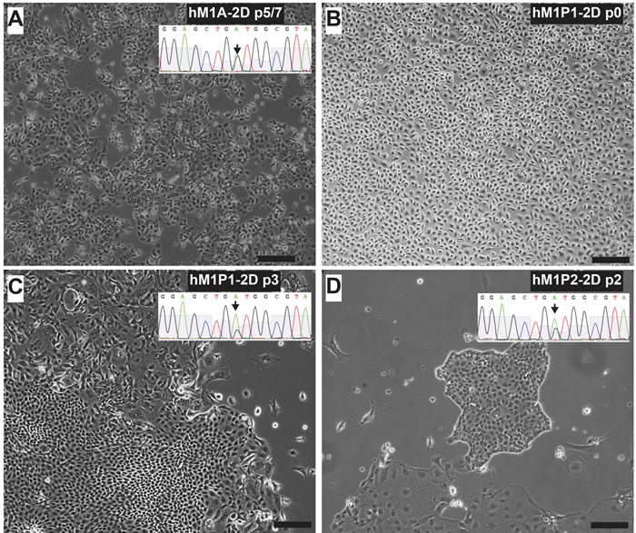 Thoracentesis-derived cell lines hM1P1 and hM1P2 contain KRAS-G12D genetic lesion.