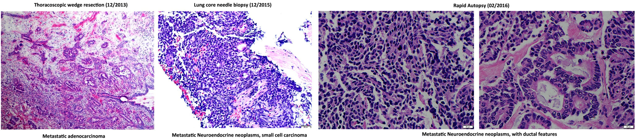 H&amp;E staining of lung metastatic biopsy taken at the beginning (left) and end (middle and right) of liquid biopsy follow up.