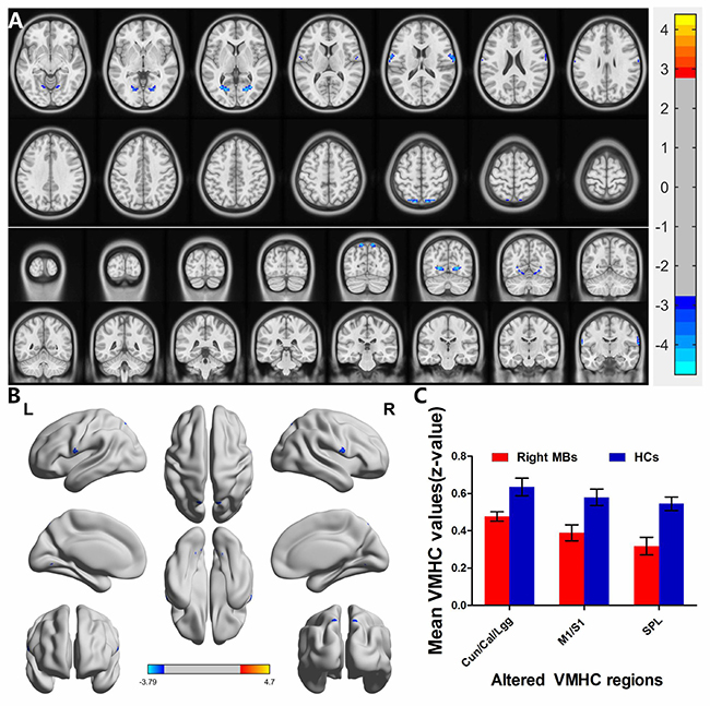 Interhemispheric