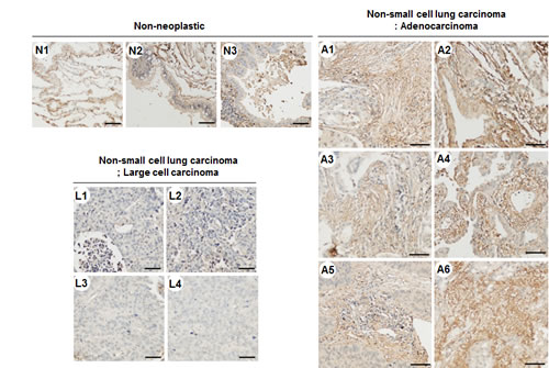 TM4SF4 expression in lung adenocarcinoma but not in large cell carcinoma.
