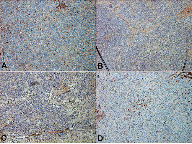 POSTN expression in in-transit melanoma.