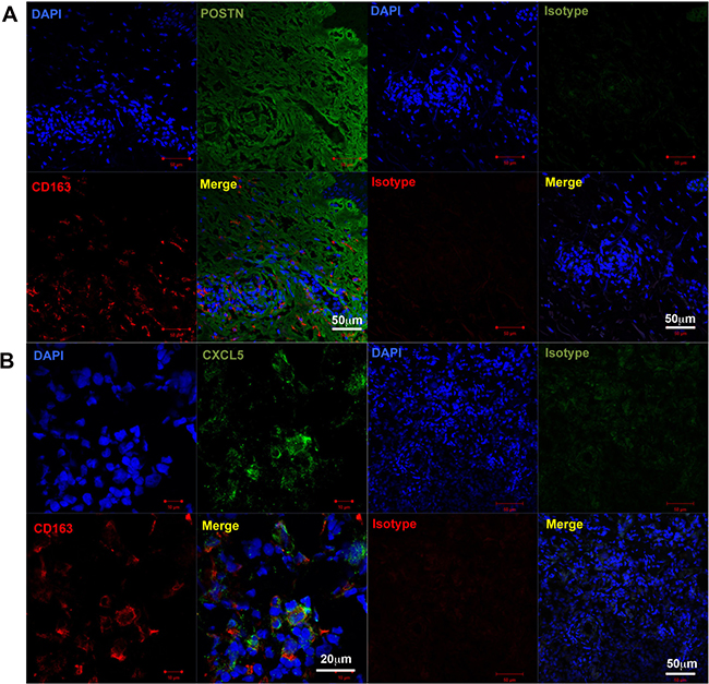 CD163+ cells in in-transit melanoma.