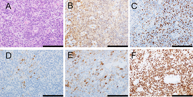 Morphology and immunophenotype of metastatic prostatic cancer in a neck lymph node.