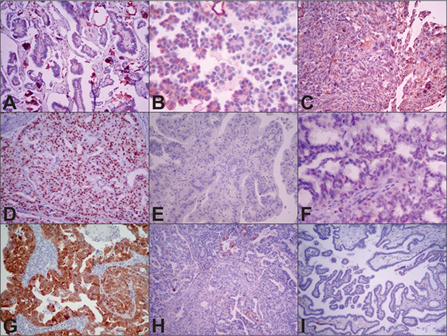 Representative WT1, p53 and p16 immunohistochemical expression in low- (LGSOC) and high-grade serous ovarian carcinoma (HGSOC).
