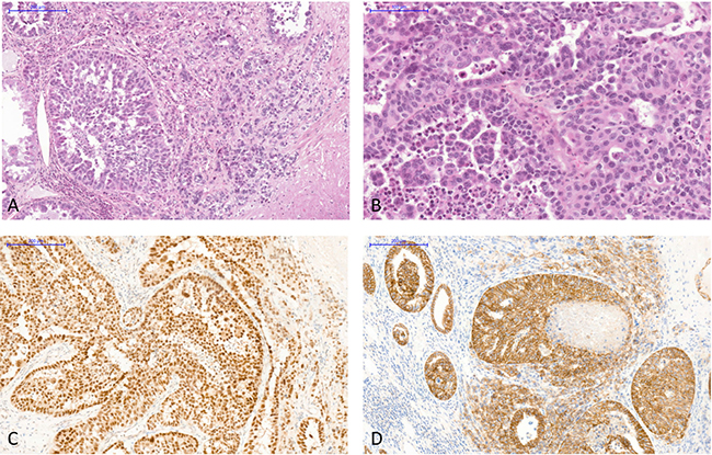 The allograft tumor exhibited histological features of collecting duct carcinoma of Bellini and immunohistochemistry staining excluded differential diagnoses.