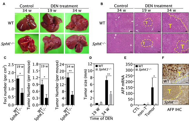 SphK1 deletion inhibits DEN-induced liver tumorigenesis.