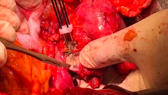 Resection with scalpel over the ablated region of tumor at tumor vessel interface.