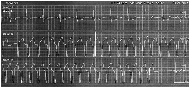Ventricular tachycardia (VT) ran 2 days after the commencement of treatment with ledipasvir and sofosbuvir in Case 1.
