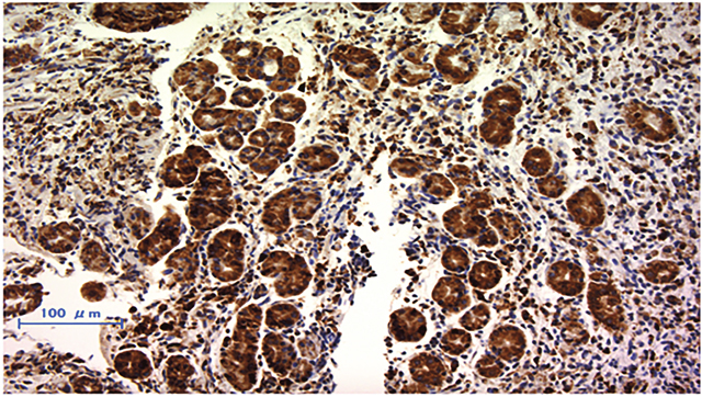 Immunohistochemically staining of RPN2 in endoscopic biopsy sample of gastric cancer.
