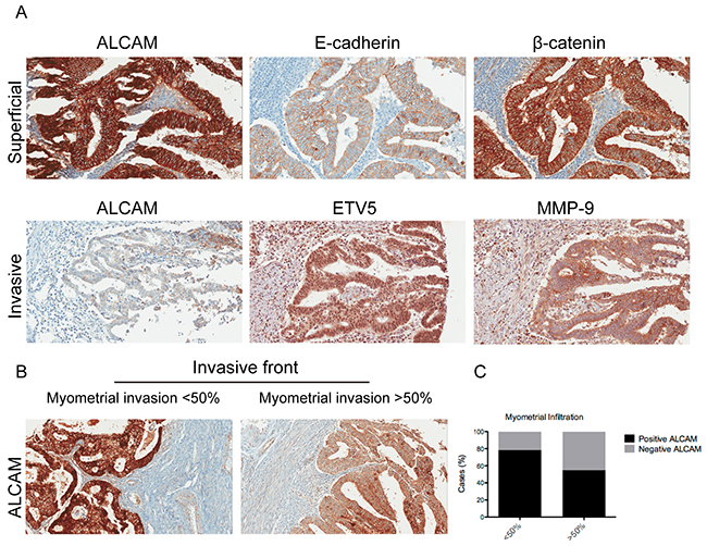 ALCAM expression presented a different correlation profile depending on its localization within the tumor and its decrease at the invasive front is a marker of myometrial invasion.