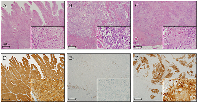 GPX2 expression is elevated in papillary urothelial carcinoma and squamous cell differentiation in radical cystectomy specimens.