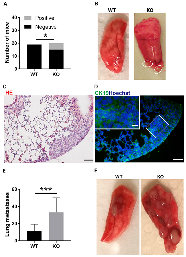 Tumor lung metastasis.