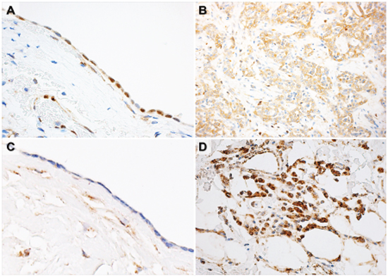 Representative figures of PDCD4 immunohistochemistry and in situ hybridization analysis of miR-21.