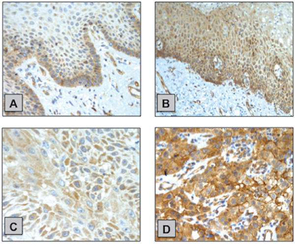 Examples of PI3K&alpha; IHC staining in NPE and PSCC samples.