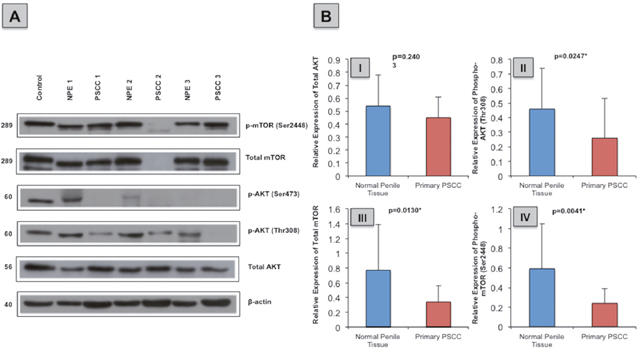 Total and phosphorylated AKT and mTOR protein expression in normal penile tissue in comparison to primary PSCC specimen.