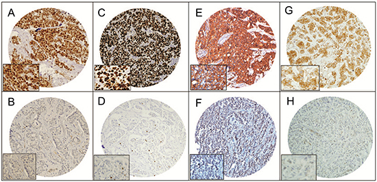 Tissue microarray based immunohistochemistry analysis of FoxM1, Ki-67, VEGF and MMP-9 in breast cancer (BC) patients.