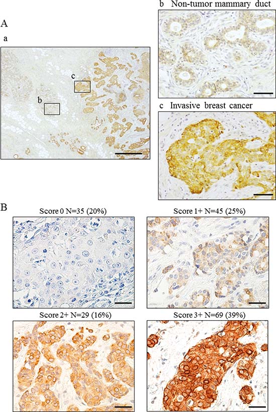 Wnt5a expression in breast cancer using breast cancer specimens.
