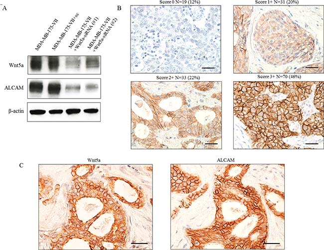 Co-expression of Wnt5a and ALCAM in ER-positive breast cancer tissue.