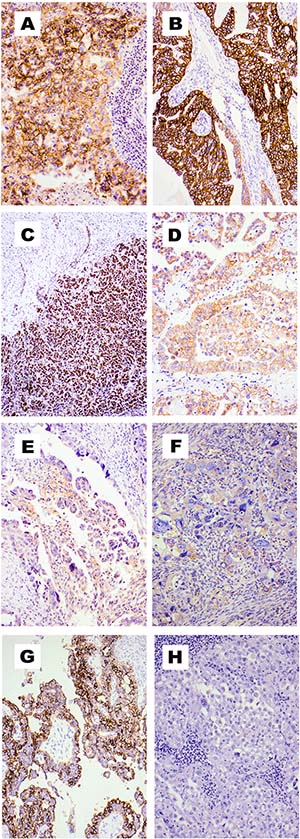 Immunohistochemical staining of tumour specimens from patients with stage III and IV ovarian cancer.