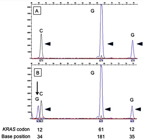 Electropherograms of the SNaPshot assay for KRAS codons 12 and 61.
