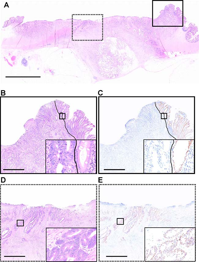 CDX2 expression in a whole formalin-fixed, paraffin-embedded section of a colorectal cancer case, which exhibits heterogeneous CDX2 expression.