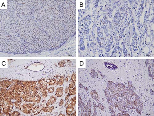 Representative immunohistochemical staining of AR, VDR, AKT Ser473 and ER&#x03B1; Ser167 in invasive ductal carcinoma.