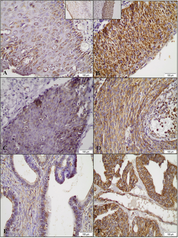 Representative examples of SOD2 immunohistochemical expression in cervical samples.