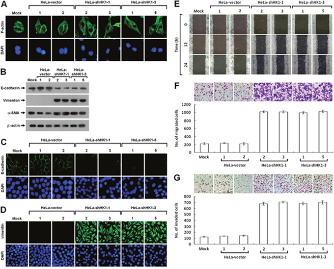 HK1 knockdown causes a typical EMT change and accelerates tumor cell motility.