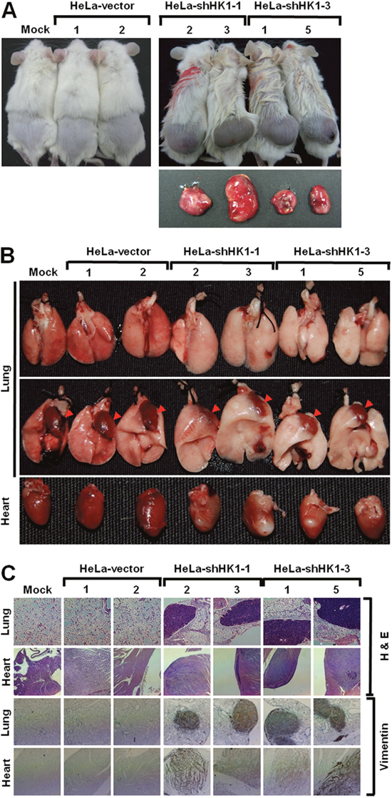 HK1 knockdown induced EMT switch accelerates tumor malignancy in vivo.