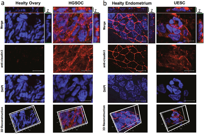 Claudin3 is out of tight junctions in in tumor samples.