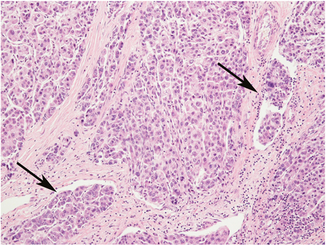 An example of &#x201C;histologically advanced&#x201D; hepatocellular carcinoma, characterized by Edmondson&#x2019;s grade 3 and several microvascular invasions (arrows).
