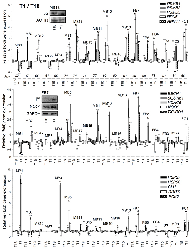 Differential genomic responses in PBMCs twenty four hrs post-treatment (T1) of MM patients with BTZ or CFZ.