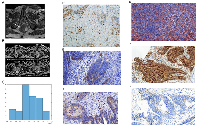 Imaging and histopathological findings in a patient with rectal cancer.