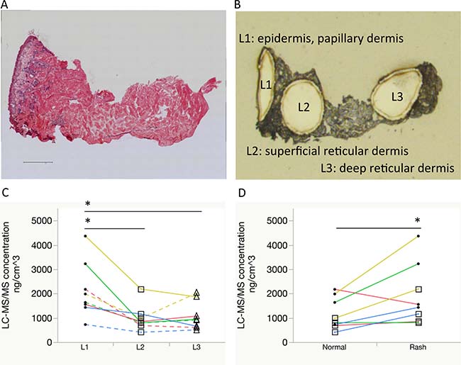 Comparisons of erlotinib focal concentrations using laser microdissection and liquid chromatography-tandem mass spectrometry.