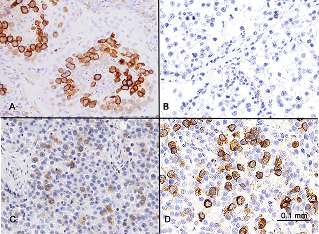 RHAMM expression in the testis and seminoma.