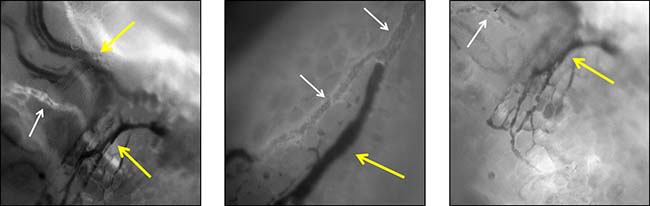 Examples of patient melanoma associated tumor vessels as directly observed by IVM in real time.