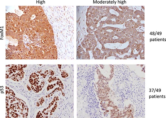FoxM1 expression is elevated in tumor tissue.