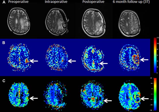 Example of a patient with incomplete resection and following residual tumor growth at the 6-month follow-up examination.