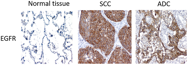 Representative images of the different IHC detection patterns of EGFR in squamous cell carcinoma and adenocarcinoma patients.