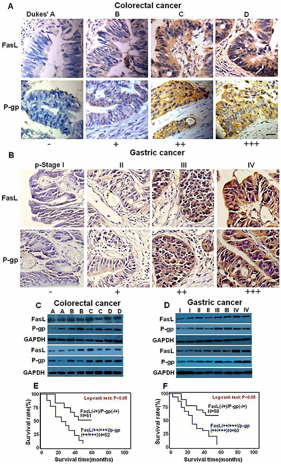 FasL and P-gp are overexpressed in human GI cancer cells.