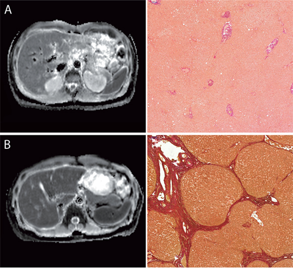 Images comparing the ADC-Maps with corresponding histopathology images with the EVG staining.