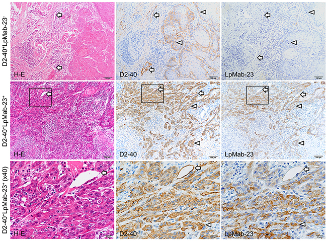 D2-40-positive and LpMab-23-negative/positive early stage tongue squamous cell carcinoma.