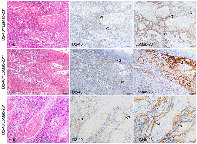 D2-40 dull/negative and LpMab-23 positive early stage tongue squamous cell carcinoma.