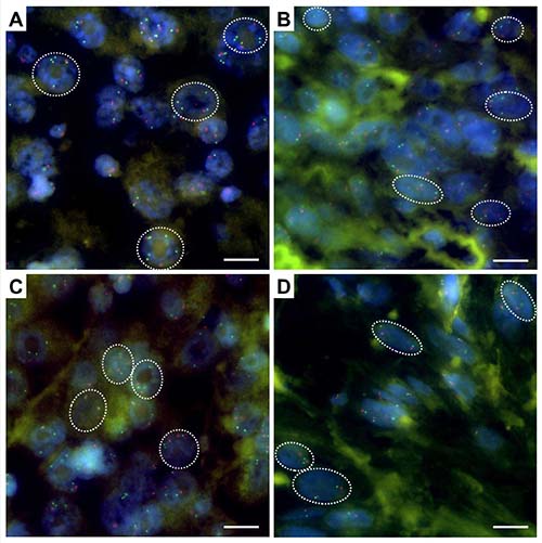 MYC/CEN 8 fluorescence in situ hybridization on interphase nulcei in AFX.
