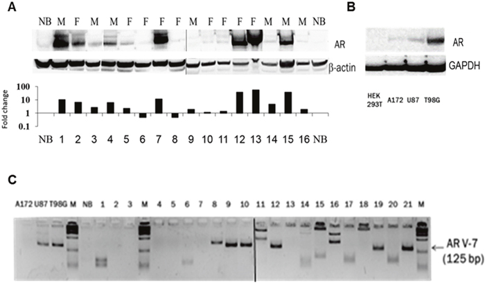 AR protein expression and the presence of the ligand-independent AR splice variant 7 (AR3) in GBM samples.