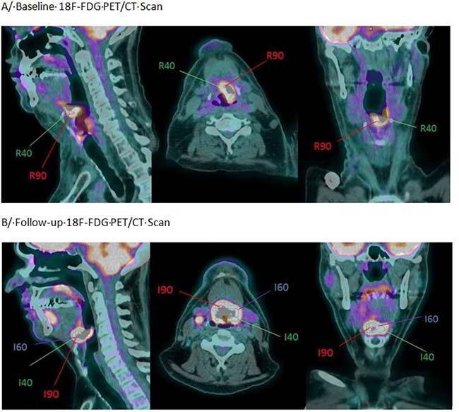 Example of an oropharyngeal cancer (stage T4N2M0) in a 54-year-old patient with residual disease.